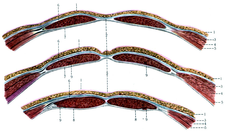 170.          (). 1 -    ; 2 - linea alba; 3 - m. obliquus abdominis externus; 4 - m. obliquus abdominis internus; 5 - m. transbersus abdominis; 6 - vagina recti abdominis; 7 - vagina m. recti abdominis ( ); 8 - peritoneum et fascia transversalis; 9 - a. epigastrica inferior