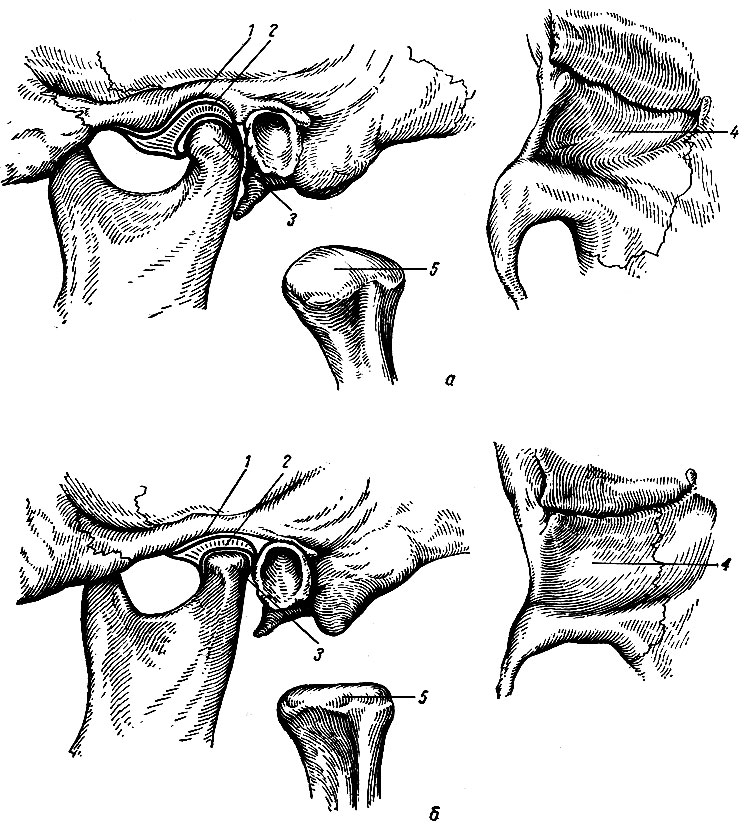 Рис. 44. Различия в строении суставных поверхностей височно-нижнечелюстного сустава (по В. Г. Михееву). а - овоидная форма мыщелкового отростка нижней челюсти и глубокая нижнечелюстная ямка; б - плоская форма мыщелкового отростка и нижнечелюстной ямки. 1 - нижнечелюстная ямка; 2 - суставной диск; 3 - мыщелковый отросток; 4 - нижнечелюстная ямка (вид снизу); 5 - мыщелковый отросток (изолирован)