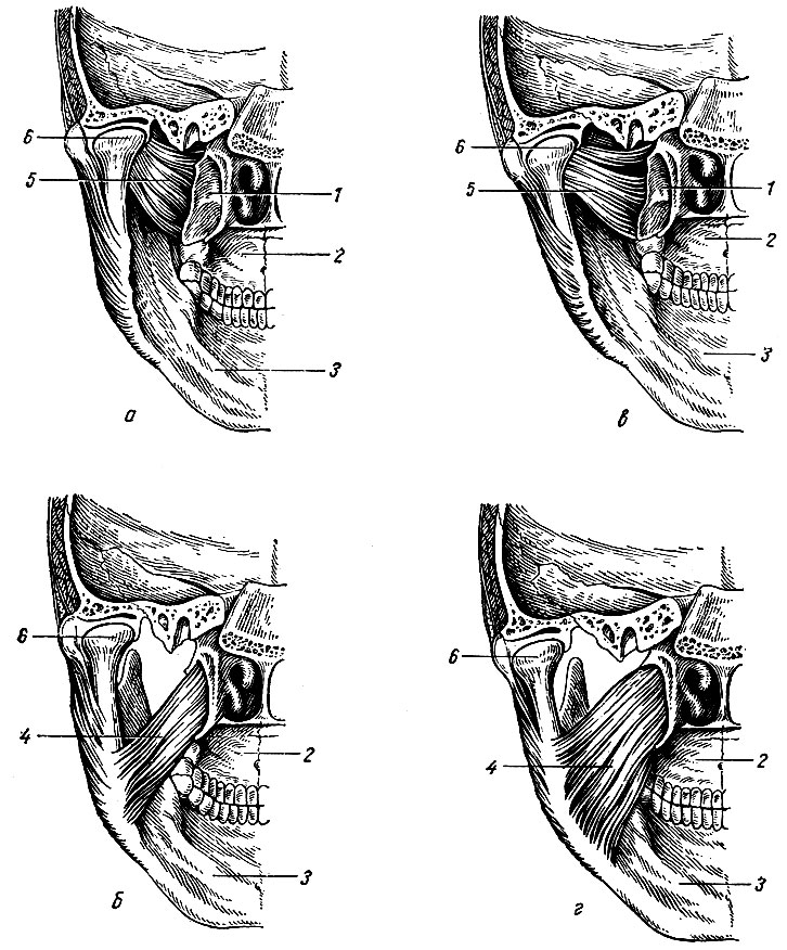 Рис. 72. Индивидуальные различия в строении латеральной (а, в) и медиальной (б, г) крыловидных мышц, а, б - у долихоцефалов; в, г - у брахицефалов), (по Н. Н. Мосолову) . 1 - латеральная пластинка крыловидного отростка; 2 - верхняя челюсть; 3 - нижняя челюсть; 4 - медиальная крыловидная мышца; 5 - латеральная крыловидная мышца; 6 - мыщелковый отросток