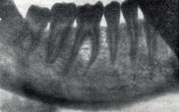 Рис. 112. Рентгенограмма постоянных зубов