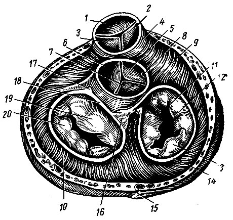 Рис. 142. Фиброзные кольца и клапаны сосудов корня сердца. 1 - передняя полулунная заслонка легочного ствола; 2 - правая полулунная заслонка легочного ствола; 3 - левая полулунная заслонка легочного ствола; 4 - артериальный конус; 5 - правая полулунная заслонка аорты; 6 - левая полулунная заслонка аорты; 7 - задняя полулунная заслонка аорты; 8 - устье правой венечной артерии; 9 - правый желудочек; 10 - левый желудочек; 11 - перегородочная створка правого предсердно-желудочкового клапана; 12 - передняя створка; 13 - задняя створка; 14 - фиброзное кольцо правого предсердно-желудочкового отверстия; 15 - большая вена сердца; 16 - правый фиброзный треугольник; 17 - левый фиброзный треугольник; 18 - левое фиброзное кольцо; 19 - передняя створка левого предсердно-желудочкового клапана; 20 - задняя створка левого предсердно-желудочкового клапана
