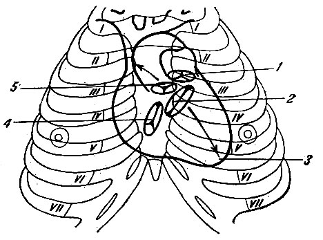 Рис. 143. Проекция на переднюю поверхность грудной стенки сердца, створчатых и полулунных клапанов. 1 - проекция легочного ствола; 2 - проекция левого предсердно-желудочкового (двустворчатого) клапана; 3 - верхушка сердца; 4 - проекция правого предсердно-желудочкового (трехстворчатого) клапана; 5 - проекция полулунного клапана аорты. Стрелками показаны места выслушивания левого предсердно-желудочкового и аортального клапанов