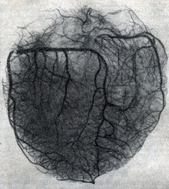 Рис. 147. Рентгенограмма артерий сердца (по Р. А. Бардиной)