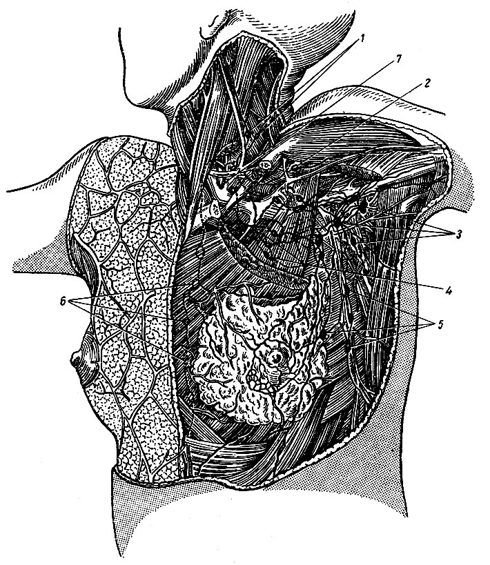 Рис. 184. Регионарные лимфатические узлы молочной железы. 1 - nodi lymphatici cervicales profundi inferiores; 2 - nodus lymphaticus infraclavicularis; 3 - nodi lymphatici axiliares; 4, 5 - nodi lymphatici pectorales; 6 - nodi lymphatici parasternals; 7 - ductus thoracicus