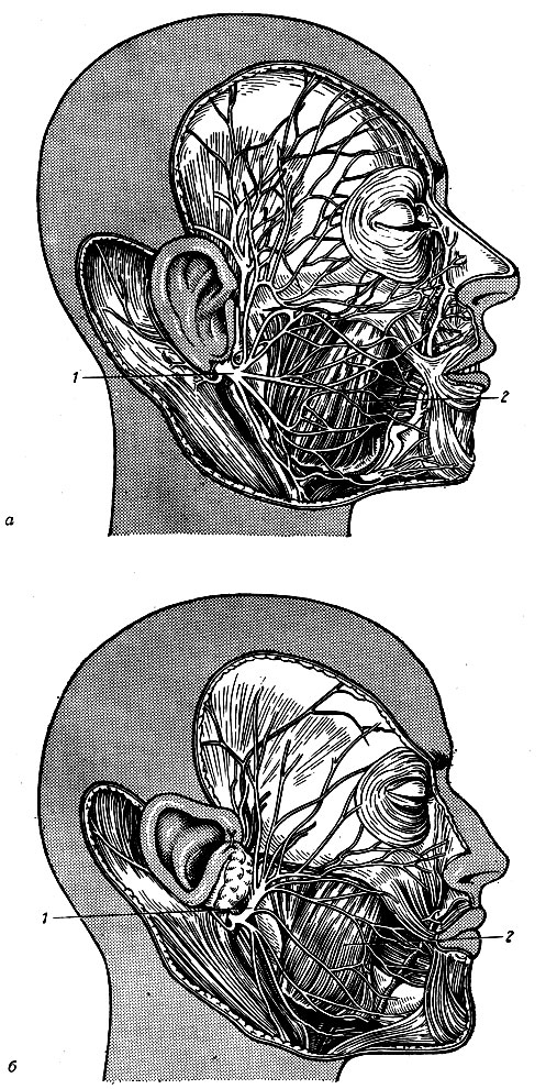 Рис. 239. Различия в строении лицевого нерва. а - сетевидное строение лицевого нерва; б - магистральное строение лицевого нерва. 1 - лицевой нерв; 2 - жевательная мышца