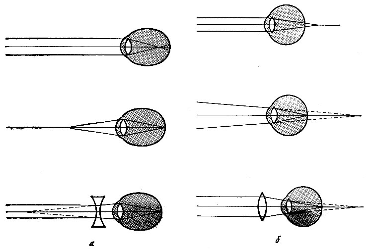 Рис. 263. Схема хода светового пучка в глазу при близорукости (а) и дальнозоркости (б)