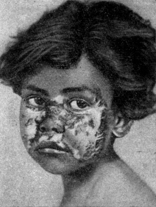 Рис. 27. Пеллагра у ребенка. На лице отмечается дерматит и пигментация (по Бикнелл и Прескотт)