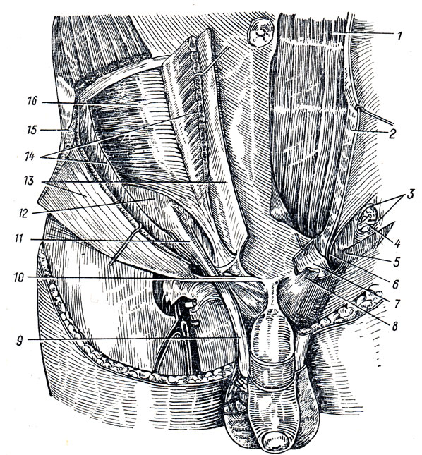 . 74.  , canalis ingulnalis ( ).  -         ,    ()   , anulus profundus (abdominalis), canalis inguinalis.  -   ;     . 1 - m. rectus abdominis; 2 - vagina m. recti abdominis (lamina anterior   ); 3 - anulus inguinalis (abdominalis) profundus; 4 - funiculus spermaticus (); 5 - crus laterale (); 6 - falx inguinalis; 7 - aponeurosis m. obliqui externi abdominis (       ); 8 - crus mediale (); 9 - funiculus spermaticus; 10 - crus mediale; 11 - m. cremaster; 12 - fascia transversalis; 13 - aponeurosis m. obliqui externi abdominis (  ); 14 - m. obliquus internus abdominis (  ); 15 - m. obliquus externus abdominis (  ); 16 - m. transversus