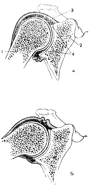 Рис. 9. Плечевой сустав в разрезе при опущенной (А) и поднятой (Б) руке: 1 - плечевая кость; 2 лопатка; 3 - суставная сумка; 4 - покрытая хрящом суставная поверхность костей