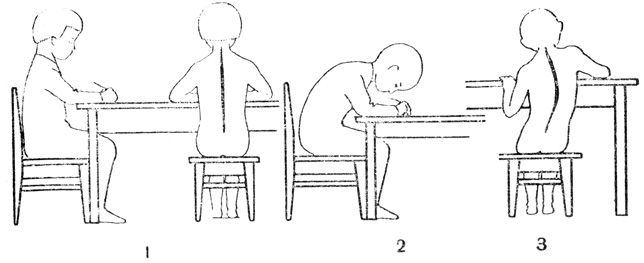 Рис. 22. Положение тела ребенка при сидении в зависимости от дифференции: 1 - дифференция достаточная; 2 - дифференция малая; 3 - дифференция большая