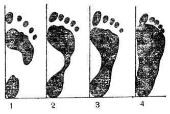 Рис. 24. Отпечатки нормальной (1, 2, 3) и плоской (4) стопы