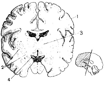 Рис. 27. Серое и белое вещество на поперечном разрезе головного мозга: 1 - кора больших полушарий; 2 - подкорковые двигательные ядра; 3 - бугры промежуточного мозга; 4 - подбугровая область; справа - схема разреза
