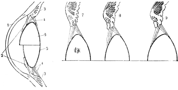 Рис. 42. Изменение хрусталика при аккомодации: 1 - роговица; 2 - радужка; 3 - ресничное тело; 4 - упругие волокна; 5 - хрусталик при установке зрения на даль; 6 - хрусталик при сокращении ресничной мышцы; 7 - ресничная мышца; 8 - ресничная мышца сократилась, волокна не натянуты; 9 - хрусталик стал более выпуклым, натяжение волокон восстановилось