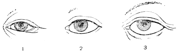 Рис. 43. Увеличение глазной щели с возрастом: 1 - глаз новорожденного; 2 - глаз ребенка 4-х лет; 3 - глаз взрослого человека