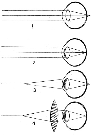 Рис. 50. Схема аккомодации дальнозоркого глаза: 1 - без аккомодации (параллельные лучи пересекаются позади сетчатки); 2 - частичная аккомодация при смотрении вдаль; 3 - при максимальной аккомодации лучи от точки, находящейся в 25 см от глаза, пересекаются позади сетчатки; 4 - исправление зрения при помощи выпуклых стекол