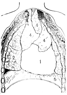 Рис. 75. Расположение органов в грудной клетке у новорожденного: 1 - сердце; 2 - правое легкое; 3 - левое легкое; 4 - зобная железа; 5 - диафрагма