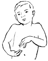 Рис. 92. Судороги мышц у ребенка, страдающего недостаточной деятельностью паращитовидных желез