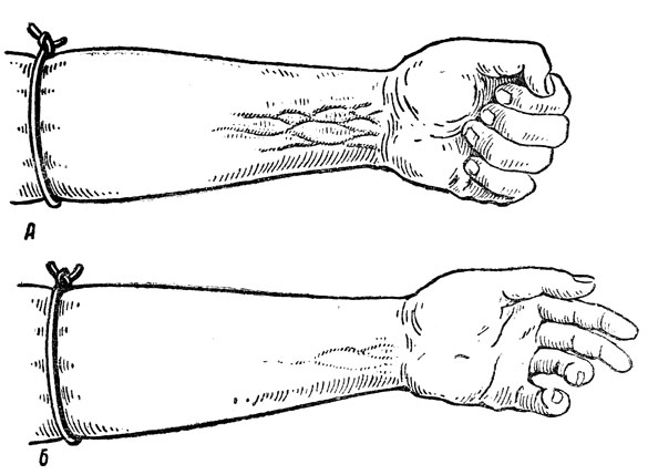 Рис. 23. Влияние мышечной работы на скорость кровотока в венах: А - рельеф вен на перетянутом предплечье руки, кисть которой сжимается в кулак и разжимается; Б - рельеф вен на перетянутом предплечье руки, находящейся то же время в состоянии покоя