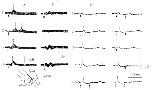 Рис. 7. Постсинаптические реакции двух нейронов (А и В, Г) моторной коры кошки на стимулы различной модальности. Хлоралозовый наркоз. А - ответы клетки на электрокожное раздражение (ЭКР) передней контралатеральной конечности (1, черный кружок); вспышку света (2, стрелка), щелчок (3, черточка), ЭКР задней ипсилатеральной конечности (4, светлый кружок); Б - запись фокальных потенциалов после гибели этой клетки; В - ответы другого нейрона на те же стимулы (1-4). На В5 и Г1 - 5 - предъявление парных стимулов одной или разных модальностей с интервалом 165 мс (см. отметки раздражений). Стрелками на схеме отмечены места регистрации  (Л. Л. Воронин, В. Л. Эзрохи, 1972)