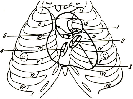 Проекция на переднюю поверхность грудной стенки сердца, створчатых и полулунных клапанов. 1 — проекция легочного ствола; 2 — проекция левого предсердно-желудочкового (двустворчатого) клапана; 3 — верхушка сердца; 4 — проекция правого предсердно-желудочкового (трехстворчатого) клапана; 5 — проекция полулунного клапана аорты. Стрелками показаны места выслушивания левого предсердно-желудочкового и аортального клапанов [1973 - Анатомия человека]
