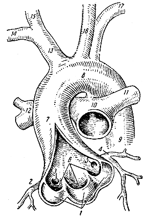 Аорта и легочный ствол (часть). 1 - полулунные клапаны аорты; 2 - правая венечная артерия; 3 - отверстие правой венечной артерии; 4 - левая венечная артерия; 5 - отверстие левой венечной артерии; 6 - углубления (пазухи) между полулунными клапанами и стенкой аорты; 7 - восходящая аорта; 8 - дуга аорты; 9 - нисходящая аорта; 10 - легочный ствол; 11 - левая легочная артерия; 12 - правая легочная артерия; 13 - плече-головной ствол; 14 - правая подключичная артерия; 15 - правая общая сонная артерия; 16 - левая общая сонная артерия; 17 - левая подключичная артерия [1967 Татаринов В Г - Анатомия и физиология]
