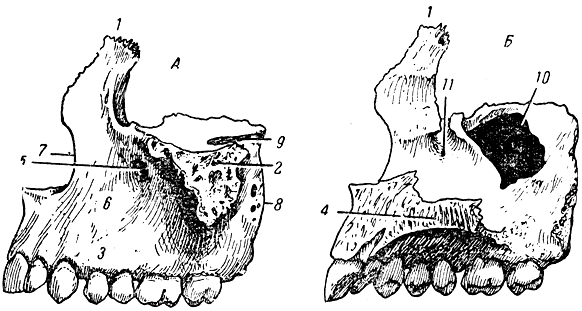 Верхняя челюсть. А - левая (вид снаружи); Б - правая (вид изнутри); 1 - лобный отросток; 2 - скуловой отросток; 3 - альвеолярный отросток; 4 - нёбный отросток; 5 - подглазничное отверстие; 6 - собачья ямка; 7 - носовая вырезка; 8 - верхнечелюстной бугор; 9 - подглазничная борозда; 10 - гайморова пазуха; 11 - слёзная борозда [1967 Татаринов В Г - Анатомия и физиология]